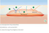 L+R Suprasorb F Folien Wundverband