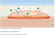 L+R Suprasorb F Folien Wundverband